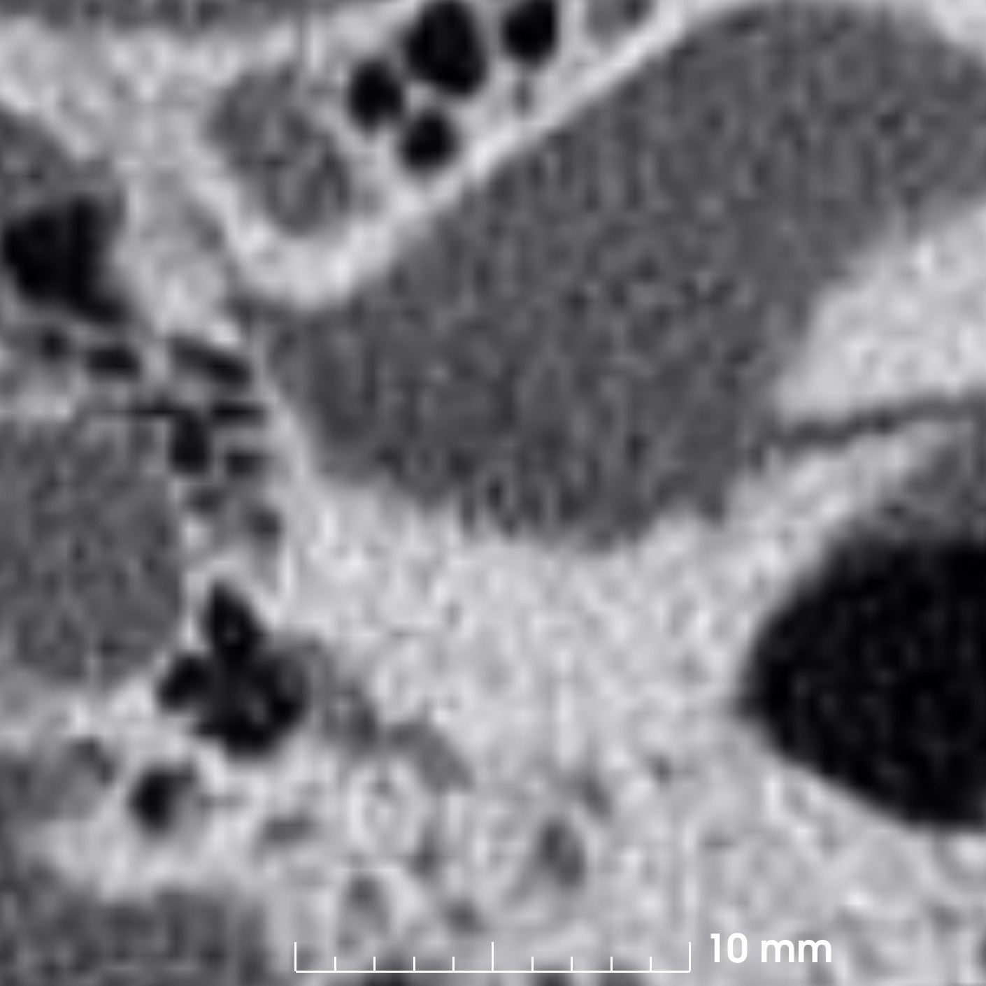 case 1 axial CT/OCT fused