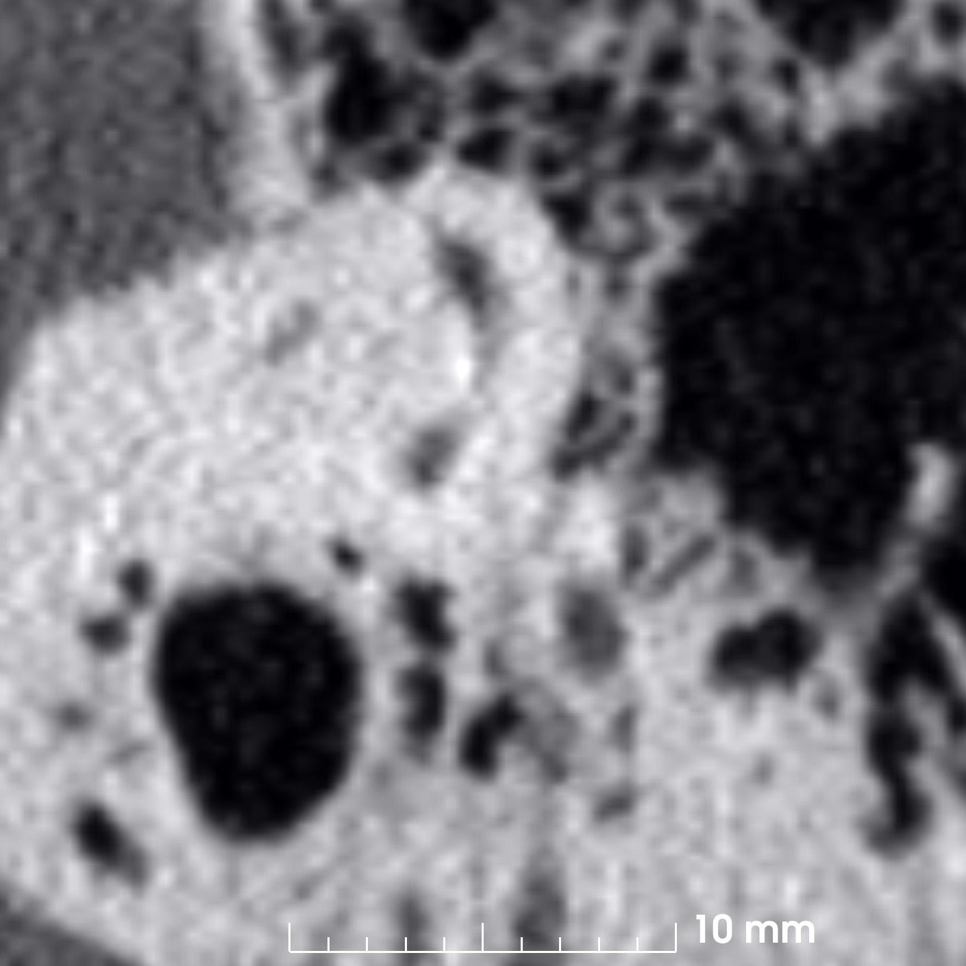 case1 coronal